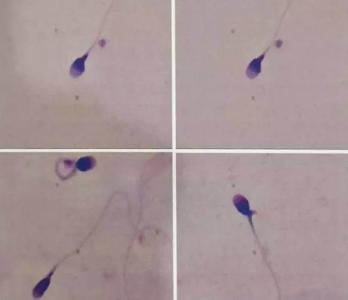 尿液粘稠、发粘正常吗？怎么回事引起的？